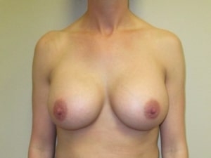 After Front