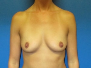 Before Front