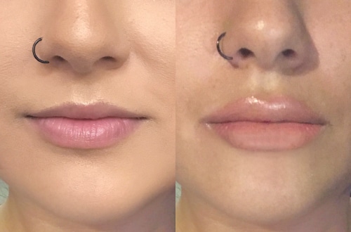 Image result for Lip Augmentation